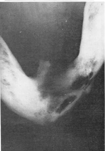 Fig.  4:  Osteomielitis  localizada  a  nivel  del  cuerpo  mandi­