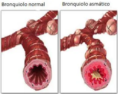 Figura 2. A la izquierda se observa un bronquio sano. A la derecha se puede observar un bronquio con obstrucción que se puede dar por la secreción de moco (mediante factores inflamatorios) y/o por el estrechamiento del músculo liso que rodea a la vía aérea
