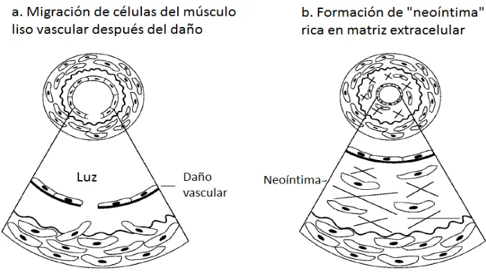 Figura 5. Remodelación de un vaso sanguíneo. a) el daño induce que células del músculo liso migren a la capa íntima