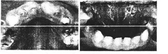 Fig. Superficies dentales con las que mastica un nit'lo con caries severas 