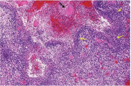 Figura 2. Microfotografía del Gioblastoma Multiforme de Grado IV con la Técnica de H-E, se muestra el área de necrosis (flecha negra) y las células en pseudoempalizada (flechas amarillas)  (www.seap.es/documents/228448/524247/02_Ribalta.pdf)