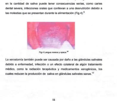 Fig.4 Lengua reseca y opaca.36