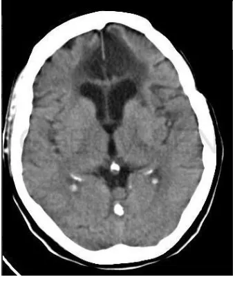 Figura 8. Infarto cerebral en lóbulo temporal y parietal derecho  