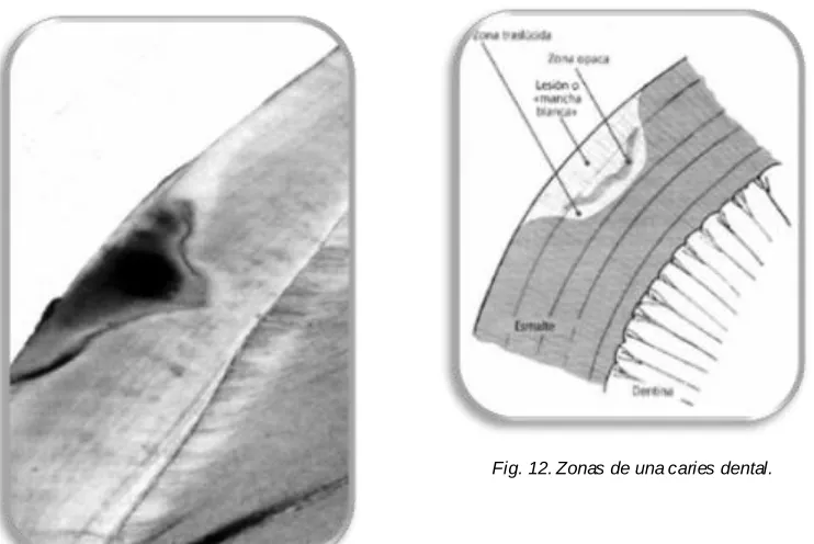 Fig. 12. Zonas de una caries dental. 