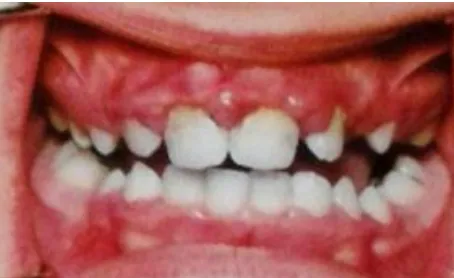 Fig. 19  Presencia de gingivitis en adolescente por mala higiene oral. 26