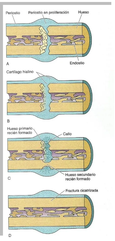 Figura 6. Esquema de los fenómenos que ocurren en la reparación de una lesión ósea. 