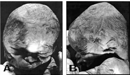 Figura 2: evidente macrocefalia Fotografías craneofaciales del caso No 2 A: Vista ventral mostrando una con angulación facial hacia el lado izquierdo; obsérvese el hipertelorismo