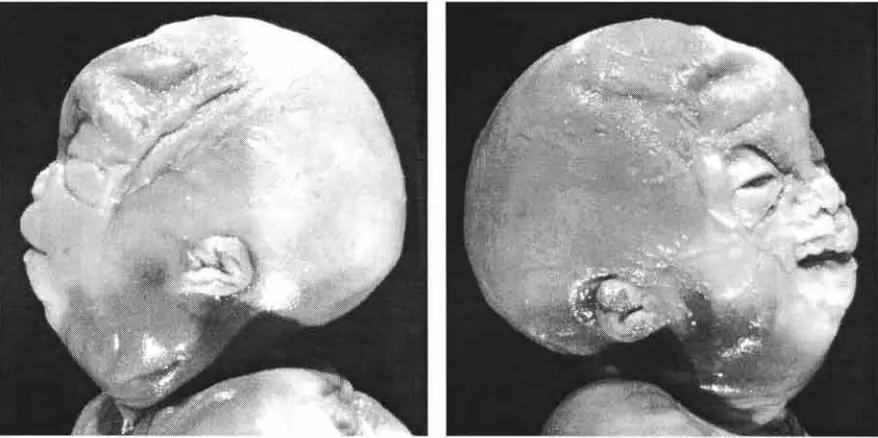 Fig. 4: C: con ojos presentan microftalmos Fotografías craneofaciales del caso N°4. B: Vista lateral izquierda