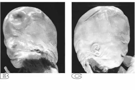 Fig. 6 Fotografías craneofaciales del Vista leteral derecha. Ambas vistas muestran pabellones auriculares de caso N°6