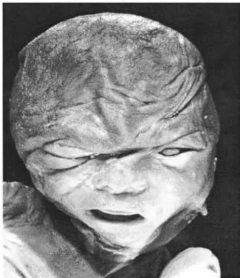 Fig. 7: caso corta cráneo, que deformación bilateral del mentan Fotografía craneofacial del No 7