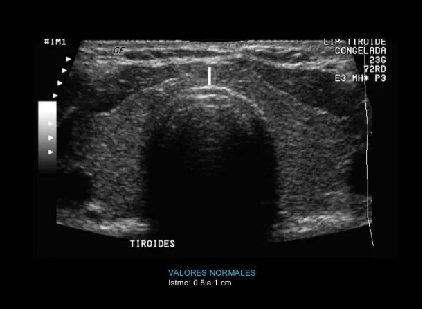 Figura 7 Ultrasonido de tiroides normal.18  