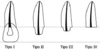 Fig. 3 Tipos de remanente radicular.  