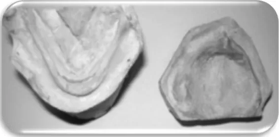 Fig.11 Radiografía lateral de cráneo de paciente con DEH, donde se muestra hipoplasia del maxilar y clase III molar