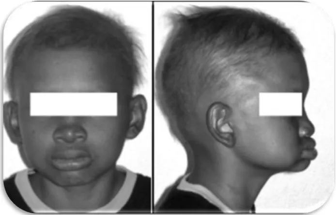 Fig.1 A) Vista frontal de paciente con DEH. B) Vista lateral de paciente con DEH.A B 