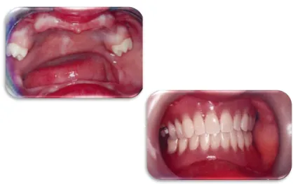 Fig. 3 A)  Fotografía intraoral de paciente con DEH donde presenta oligodoncia. B) Colocación de prótesis removible  en boca
