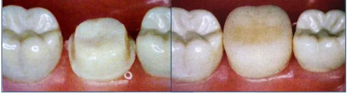 Fig. 1 Corona provisional. 