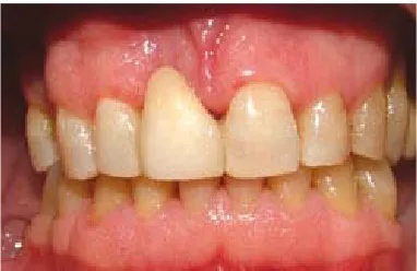 Fig. 11 Adaptación del póntico.