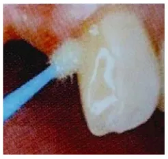 Fig. 15 Aplicación de resina  