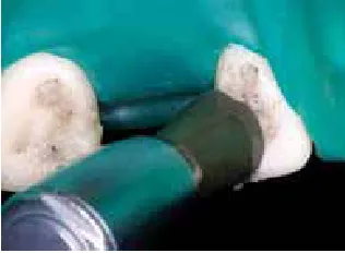 Fig. 20 Profilaxis. 