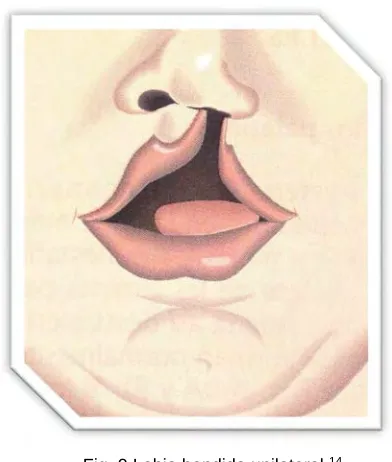 Fig. 9 Labio hendido unilateral.14