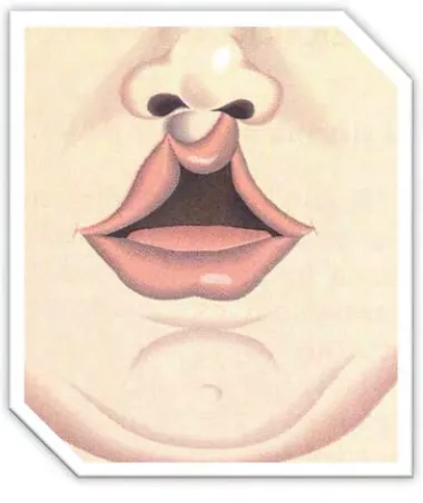 Fig. 10. Labio hendido bilateral.14