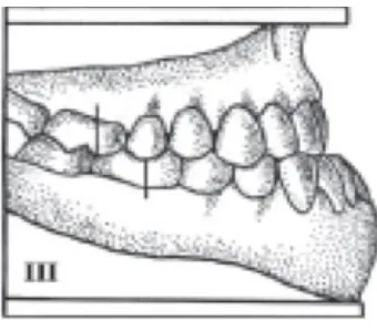 Figura 4. Clase III de Angle.1 