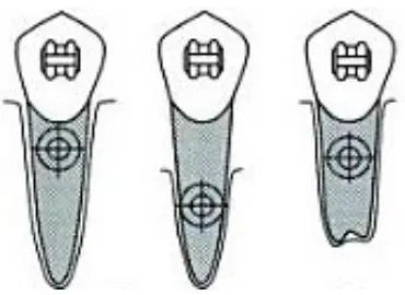 Figura 9. El centro de resistencia varía debido a la longitud radicular y cantidad de hueso.3 