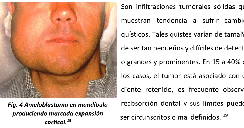 Fig. 4 Ameloblastoma en mandíbula 
