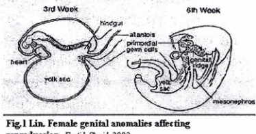 Fig,l Lin. Female genital anomalie1 affecting reproduccion. Ferti.l SUril 2002 