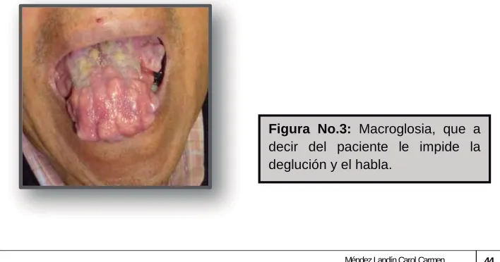 Figura No.3: Macroglosia, que a decir del paciente le impide la 