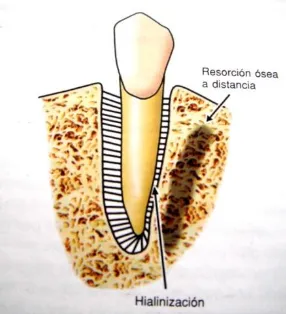 Fig. 5  Deformación del ligamento periodontal al aplicar una fuerza ortodóncica se observa un lado de presión y uno de tensión