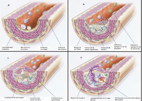 Figura 2. Diagrama de la progresión de la lesión endotelial en la aterosclerosis A. Disfunción endotelial en estadios tempranos, que preceden a la lesión de la aterosclerosis