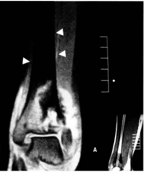 Fig. 1 D. En la imagen coronal con supresión grasa (SPGR-FatSat) se muestra la médula ósea proximal normal (cabezas de flecha)