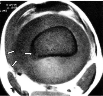 Fig. 2. Osteosarcoma osteogénico femoral distal en un varón de 14 años. 2 B. En la imagen axial Tlse observa la hipointensidad difusa de la médula ósea (flecha blanca) y la afectación concéntrica del tejido blando
