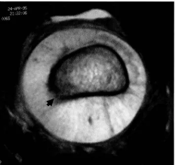Fig. 2. Osteosarcoma osteogénico femoral distal en un varón de 14 años. 2 C. En la imagen axial T2 es evidente la reacción perióstica y la disrupción de la cortical ósea (cabeza de flecha)