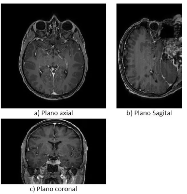 Figura 2.5. Planos anatómicos de imágenes de RM cerebral. Planos sagital y coronal  reconstruidos por el software del proyecto