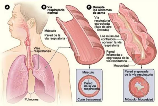 Figura  2.  Fisiopatología  del  asma.  Extraída  de  The  National  Heart,  Lung  and  Blood Institute