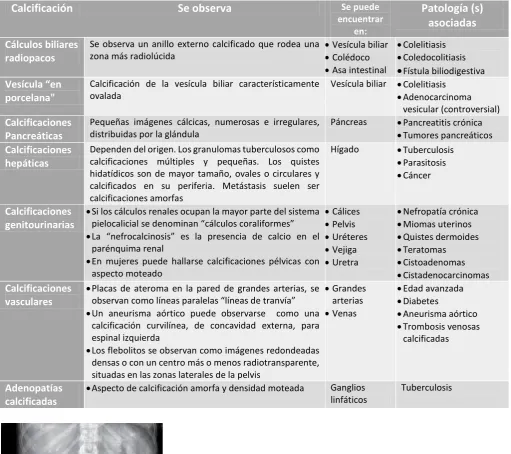 Fig.2 Ejemplo de colelitiasis 