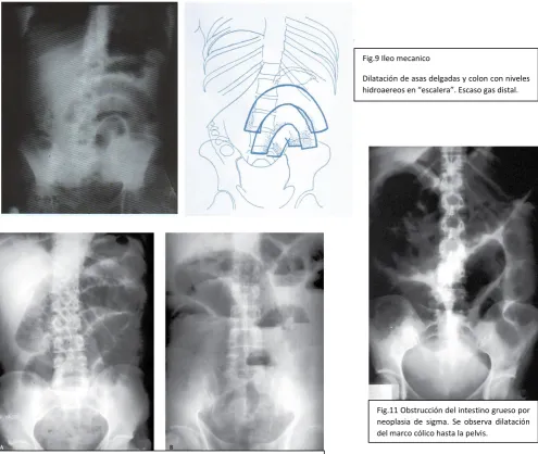Fig.9 Ileo mecanico 
