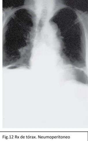 Fig.12 Rx de tórax. Neumoperitoneo 