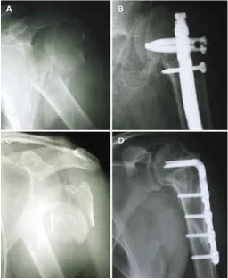 Figura 7. A) Fractura en dos partes del cuello humeral. B) Tratamiento de dicha fractura mediante osteosíntesis con clavo intramedular bloqueado