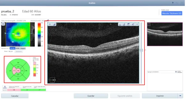 Figura  13.-  Análisis  de  la  captura  de  OCT  centrada  y  diagrama  ETDRS  descentrado  (OCT  Primus  200,  Zeiss) 