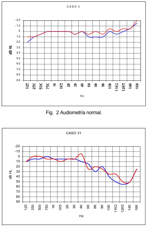 Fig.  4 Audiometría con algunos problemas. 