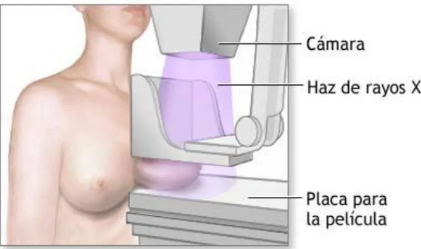 Fig. 3 Mamografía  (Tomado de: [30]) 