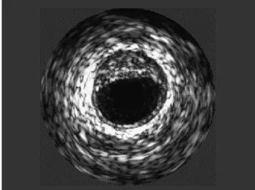 Fig. 6 -  Example of an intravascular image with a lesion between 10 and 2 o’clock.  