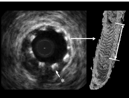 Fig. 7. Echo image of stent with struts (*) and corresponding 3D image. (Courtesy N. Bruining) 