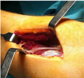 Fig. 2 Dissection between the second radial and the common extensor of the fingers and section of the supinator muscle