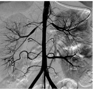 Figura 2 - Angiografía renal