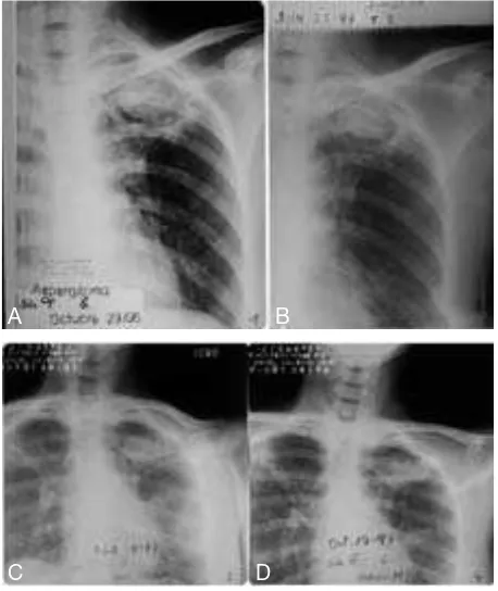 Figura 1. Aspergiloma pulmonar. Se observa la presencia de una masa