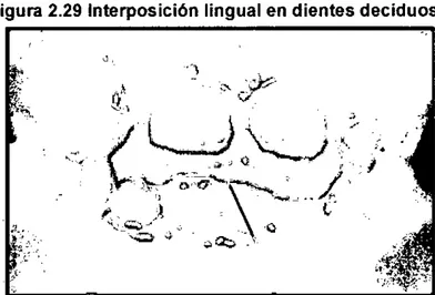 Figura 2.29 Interposición lingual en dientes deciduos 